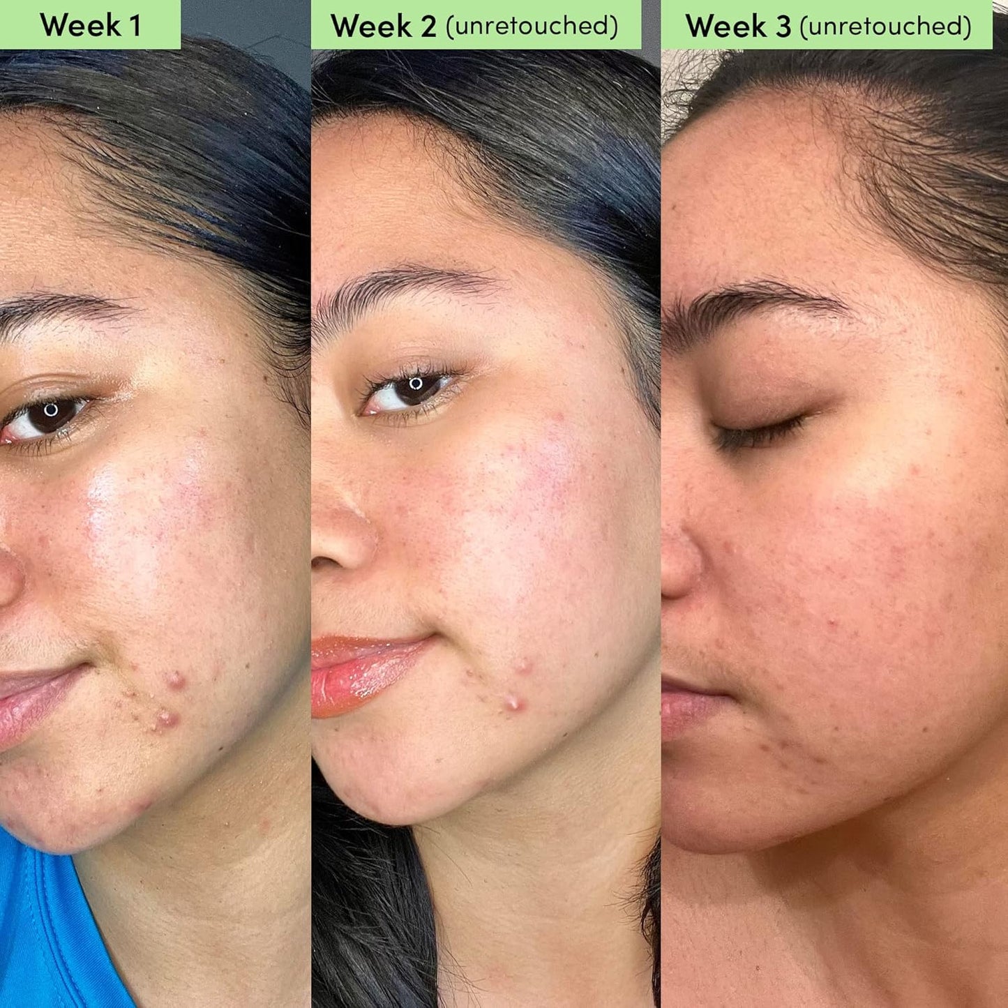 Sand & Sky Oil Control Blemish Clearing Clay Face Mask with Salicylic Acid & Niacinamide - Blemish Fighting Mask, Minimizes Redness, Tightens Pores