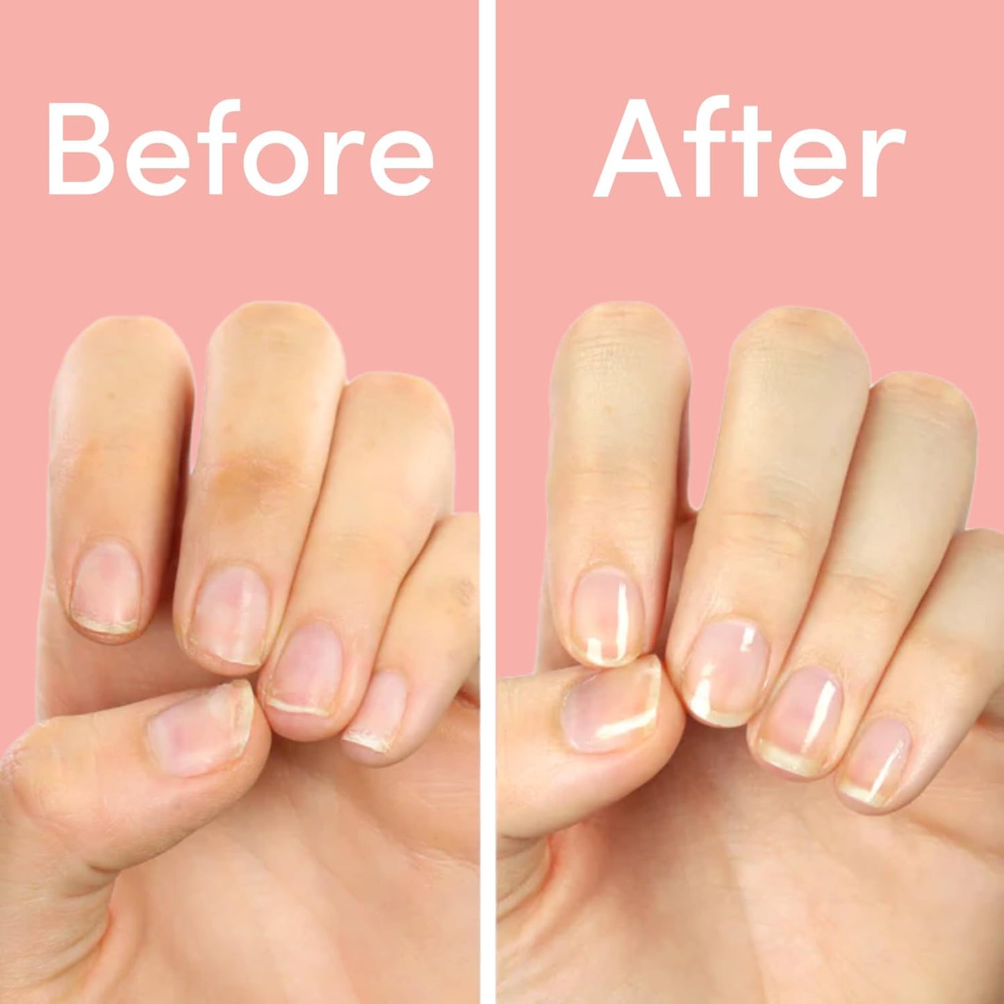 ella+mila "First Aid Kiss" Nail Strengthener and Growth Treatment - Nail Repair Solution & Growth Treatment for Thin, Brittle & Damaged Nails - Nail Hardener with Vitamin E (2-Pack)