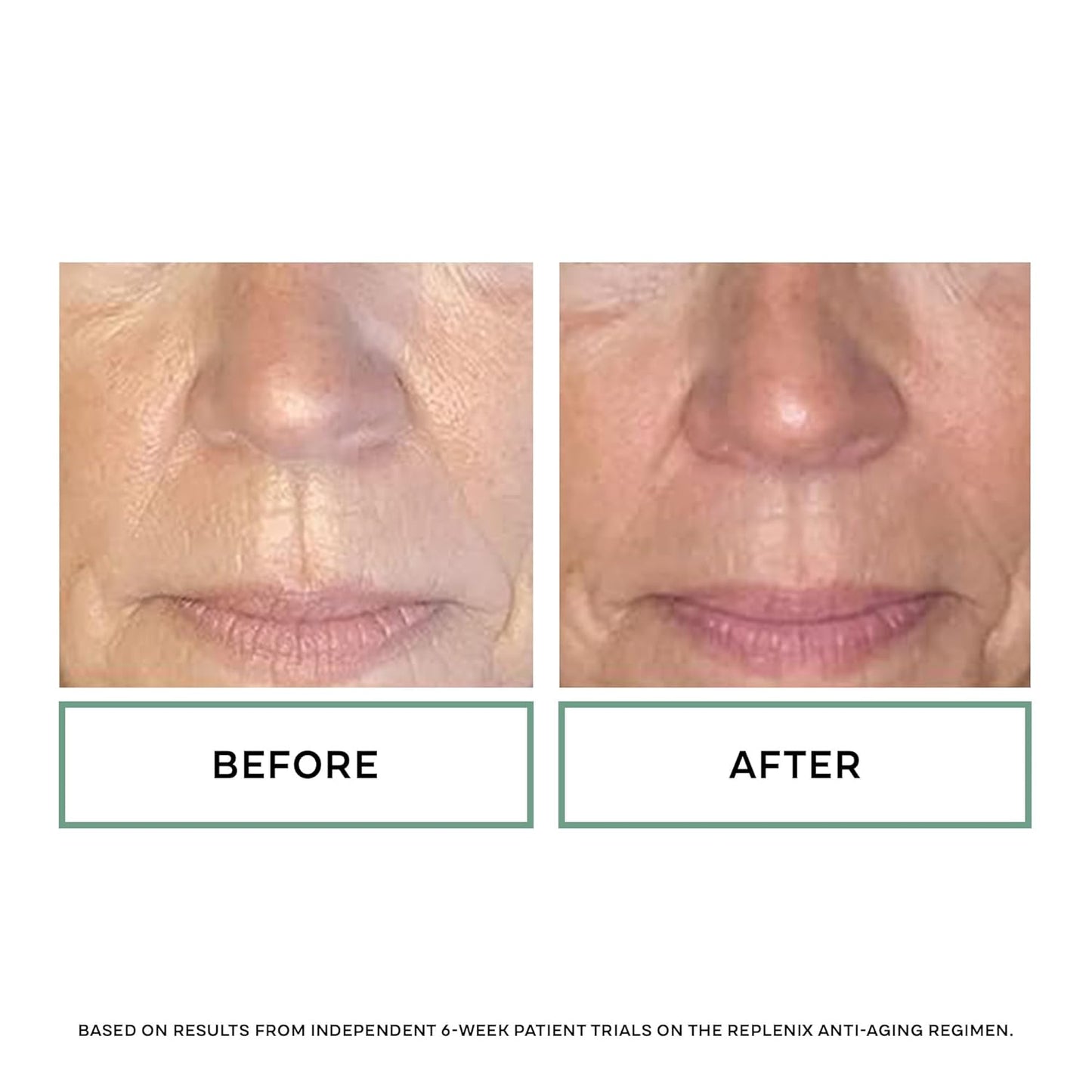 Replenix Glycolic Acid 20% Resurfacing Cream, Hydrating & Lightweight Medical-Grade Exfoliating Face Moisturizer for Skin Discoloration (1.7 oz)