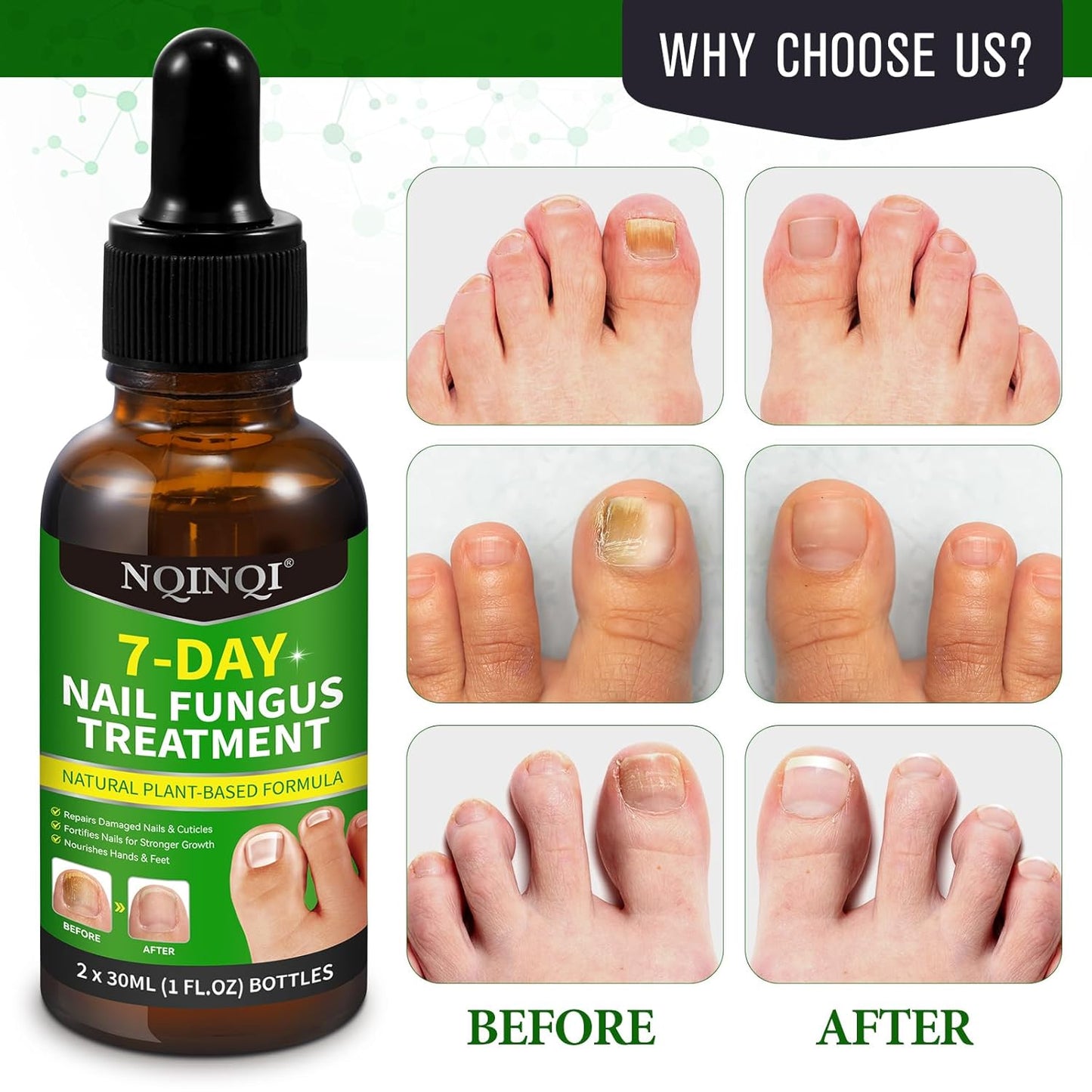Nail Treatment, 7 Days Nail Treatment Extra Strength, Nail Liquid Maximum Strength - Ginger Nail Treatment Serum for Strengthen & Promote Nail Growth with Natural Plant Formula- 2PCS