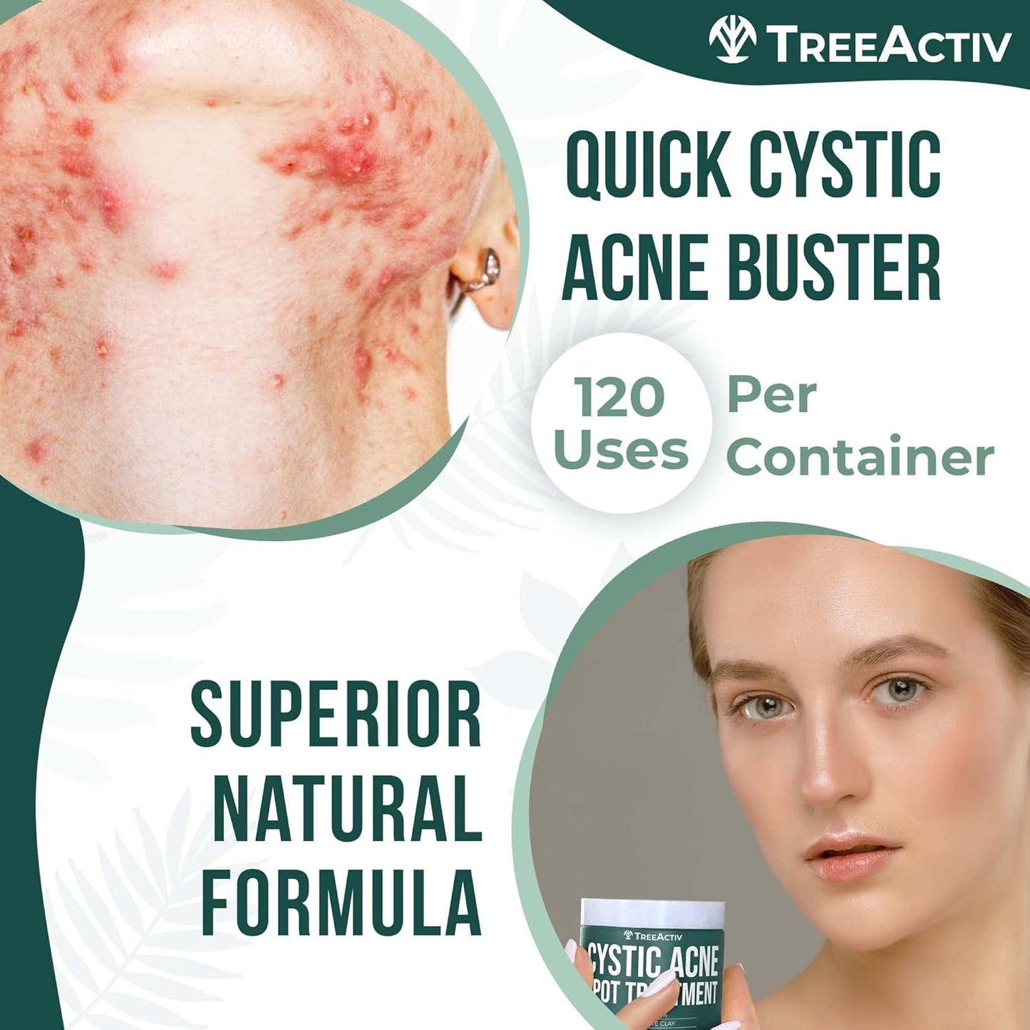 TreeActiv Cystic Acne Spot Treatment, Hormonal & Overnight Sulfur Cystic Treatment For Face, Pimples, and Blemishes for Adults, Men, and Women - 0.5oz 120+ Uses