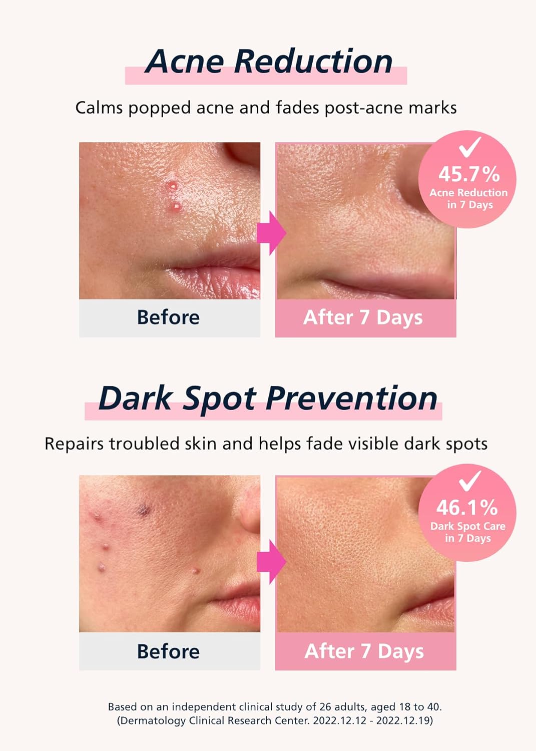 EasyDerm Real Calming Microdart Pimple Patches, Clear Micropoint | Niacinamide, Hyaluronic Acid, EGF Acne Dark Spot Care, K-beauty | 6 counts, Micro Piont length : 285μm