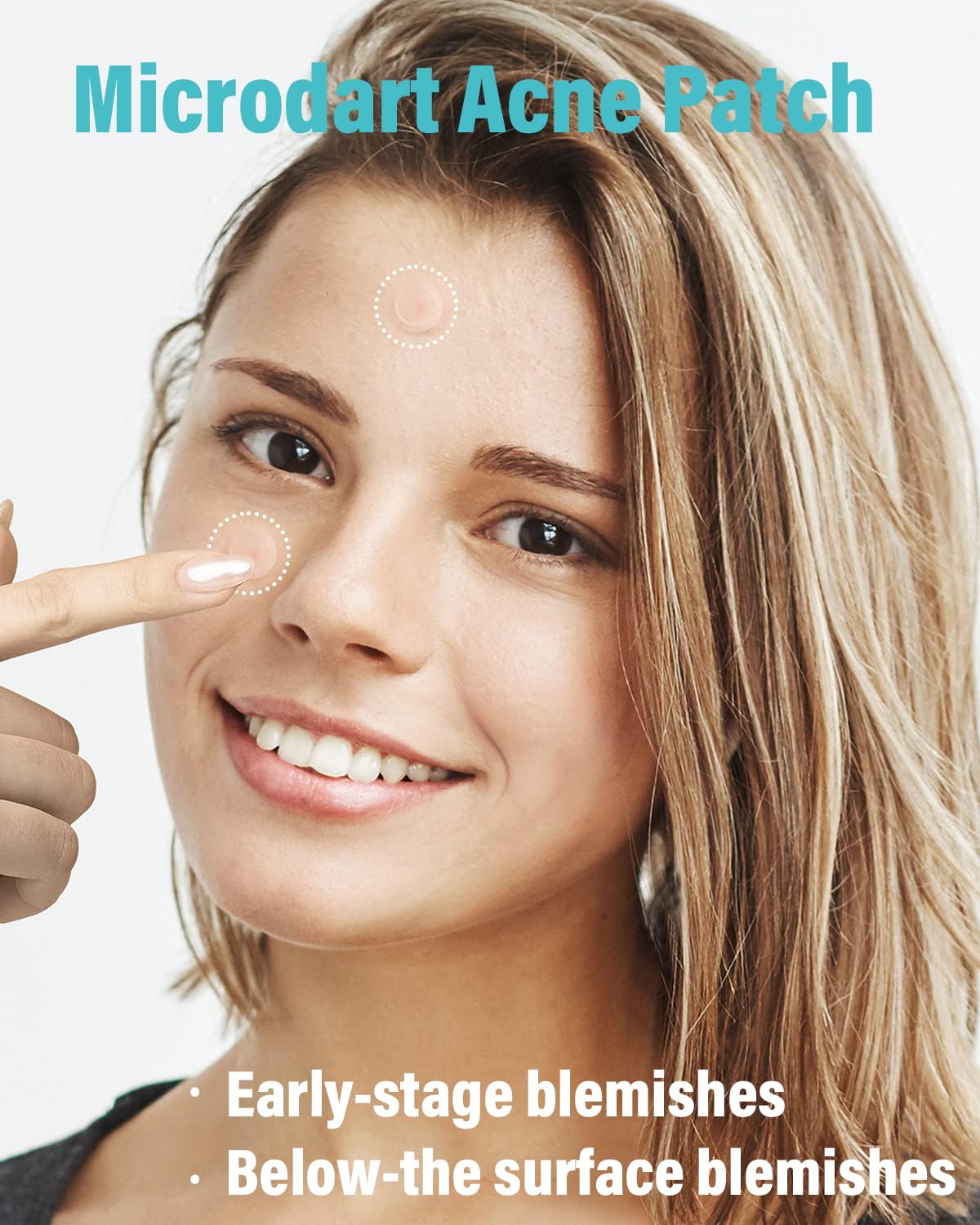 Microdart Acne Patch (54 Patches) - Hyaluronate Acid & Salicylic Acid Hydrocolloid Pimple Patch for Deep, Early and Hidden Blemishes (54 Count (Pack of 1))