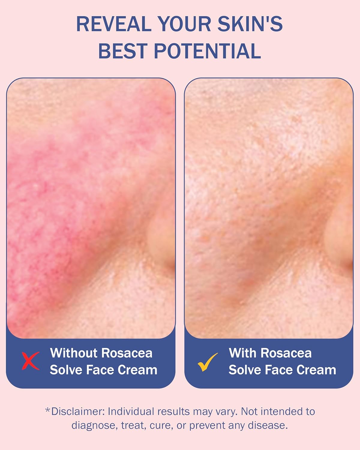 Rosacea Treatment Skincare Face Wash for Women & Men - Gentle Face Cleanser Moisturizer Redness Reducing Skin Care with Aloe Vera, Hyaluronic Acid & Fruit Extracts, Made in USA (8 fl. oz)