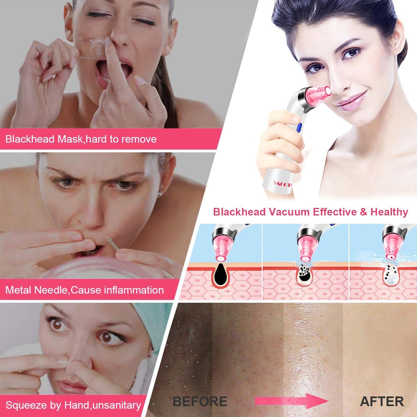 Blackhead Remover Pore Vacuum, Face Suction Pore Cleanser, 5 Suction Power Electric Blackhead Extractor Tool, 4 Probes, Blackhead Suction Remover for Women & Men (Pink)