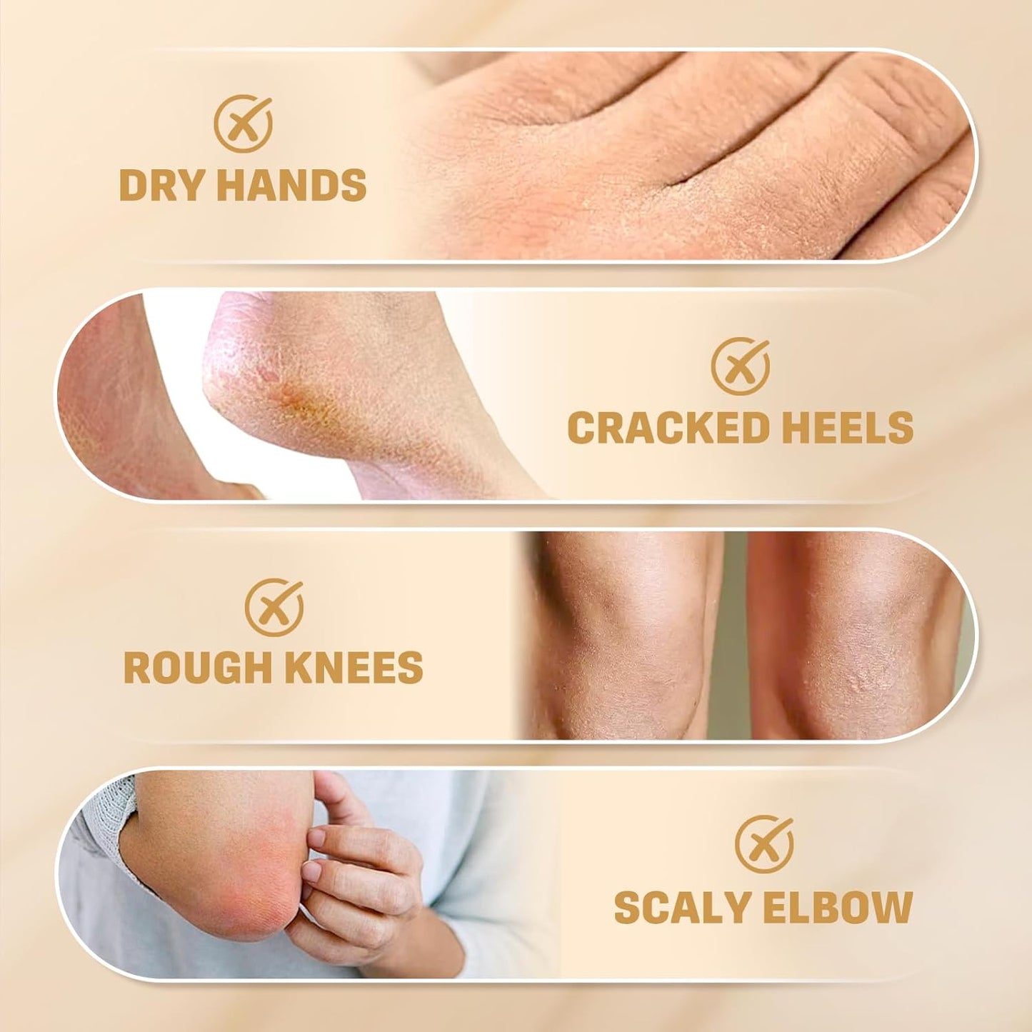40% Urea Cream with 2% Salicylic Acid, Urea Cream 40 Percent for Feet & Hands- Maximum Strength Moisturizer for Rough, Dry, Thick & Cracked Skin, Callus Remover, Deep Hydration, 150g