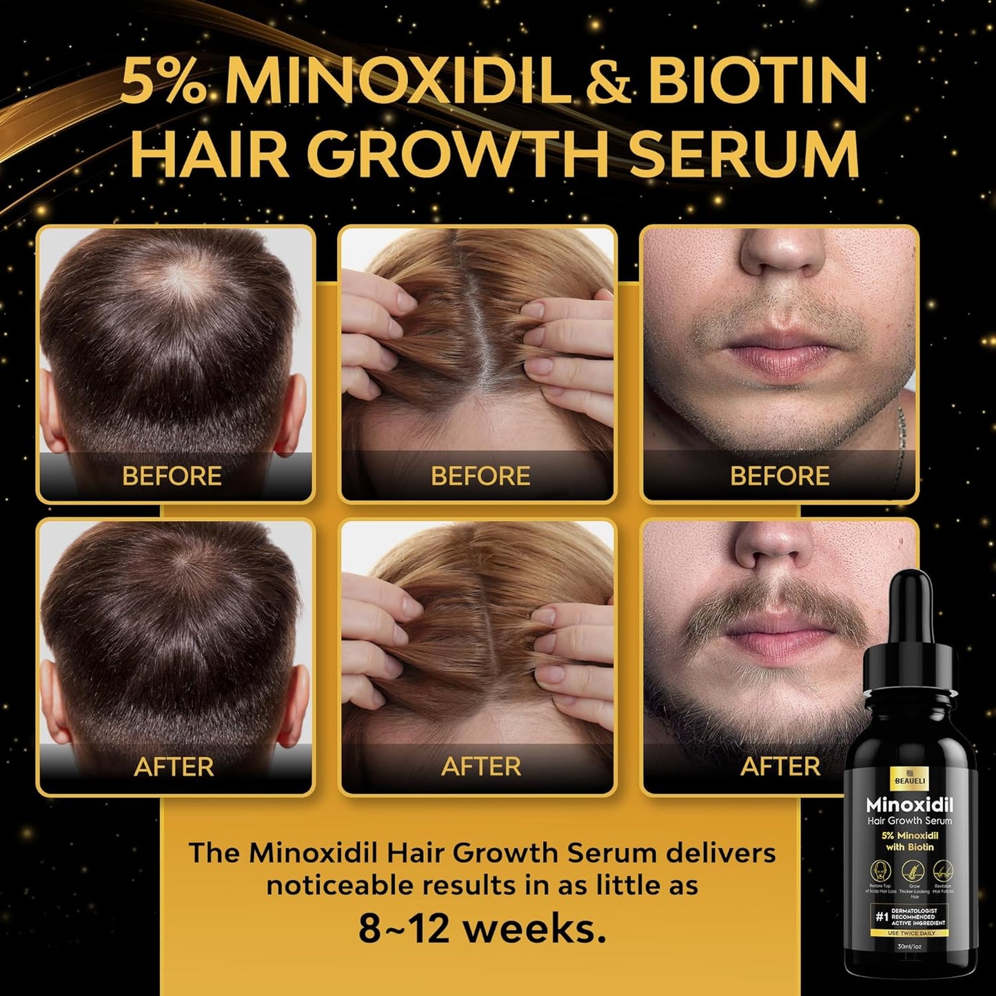 5% Minoxidil for Men & Women Hair Growth, Beard Growth, Hair Loss Treatment, Unisex Adult, Unscented Foam, 1oz