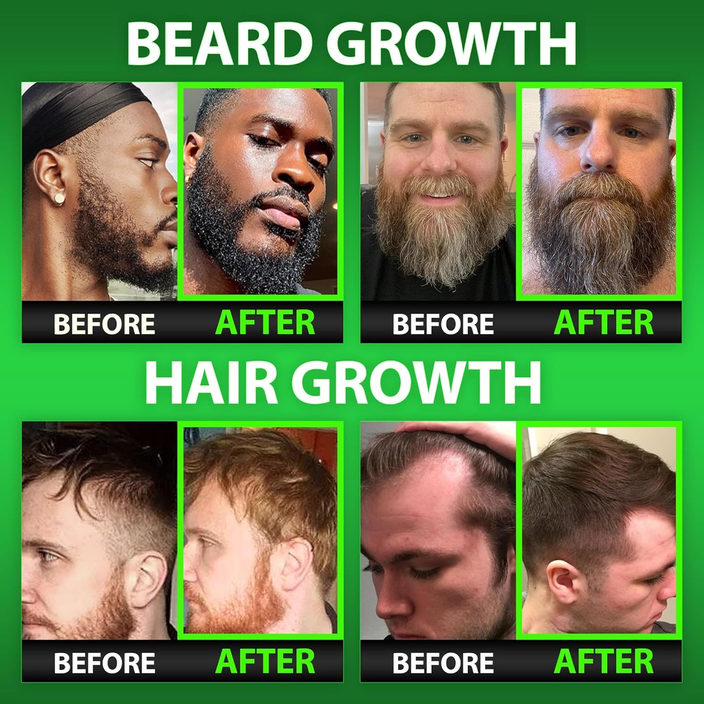Biotin Gummies 620,000mcg + Liquid Biotin Drops with Collagen Peptides – Men's Beard Growth Kit for Thicker Fuller Beard – Beard & Hair Growth Vitamins with MSM, Keratin, Bamboo & Zinc