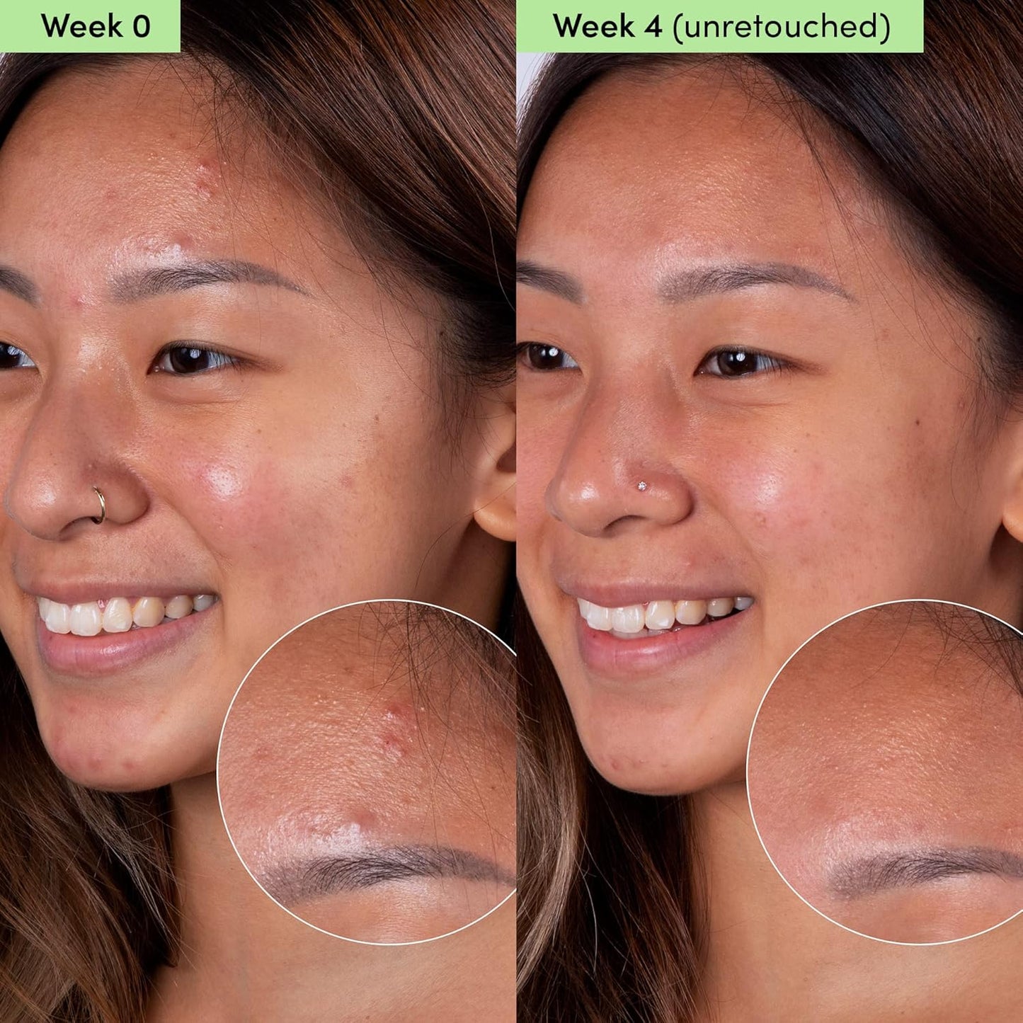 Sand & Sky Oil Control Blemish Clearing Clay Face Mask with Salicylic Acid & Niacinamide - Blemish Fighting Mask, Minimizes Redness, Tightens Pores