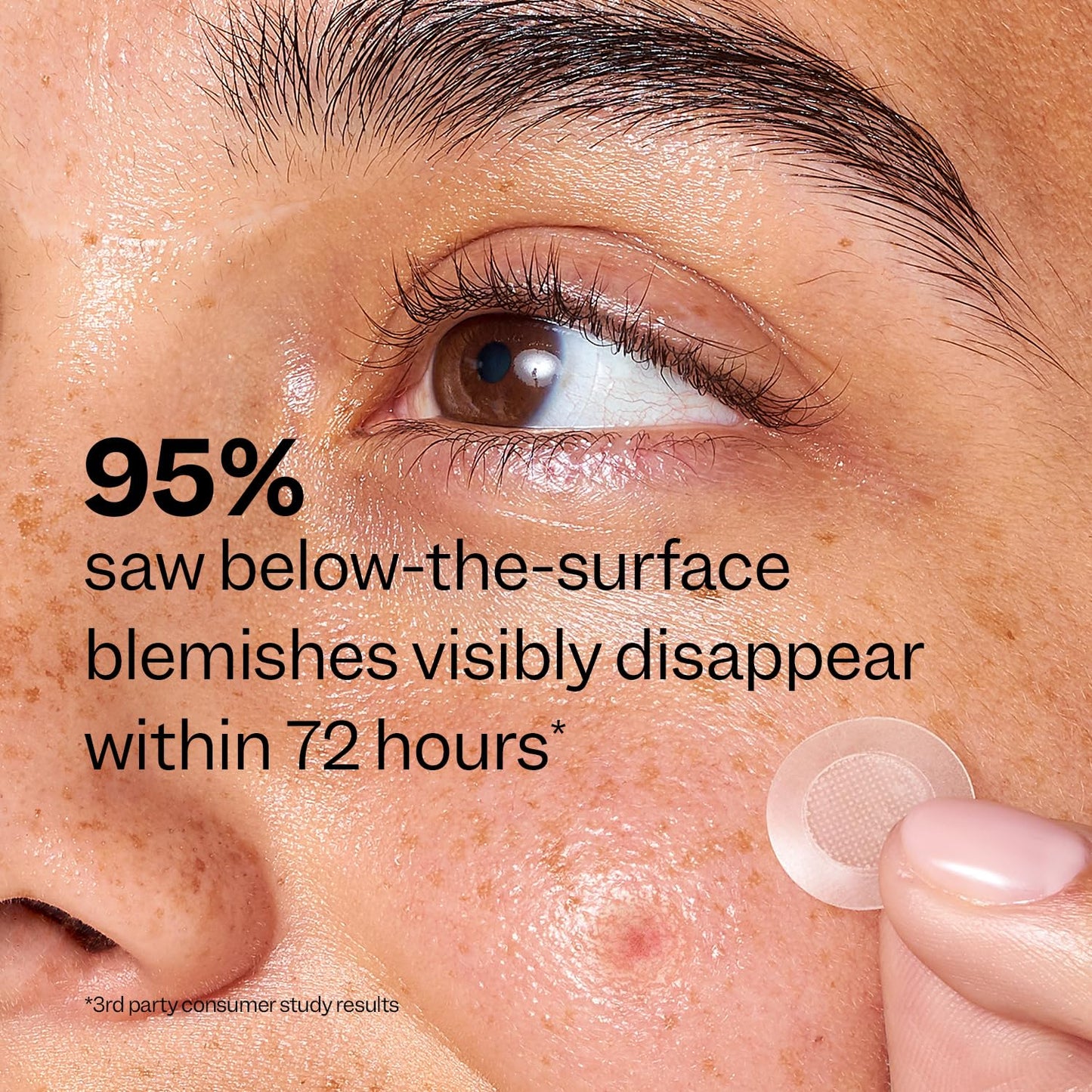 Peach Slices | Deep Blemish Microdarts | Acne Patch | Early Stage & Deep Pimples | Salicylic Acid | Tea Tree Oil | Niacinamide | Cica | Hyaluronic Acid | 9 Patches